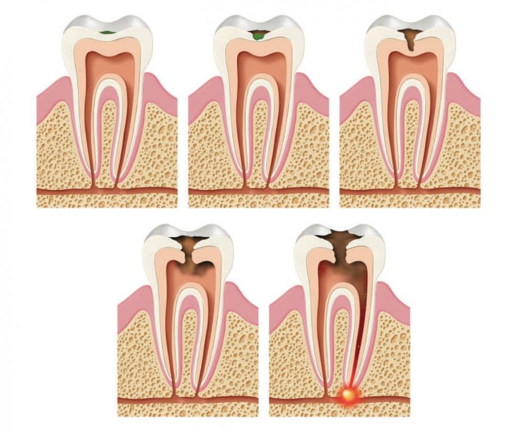 Abcès dentaire