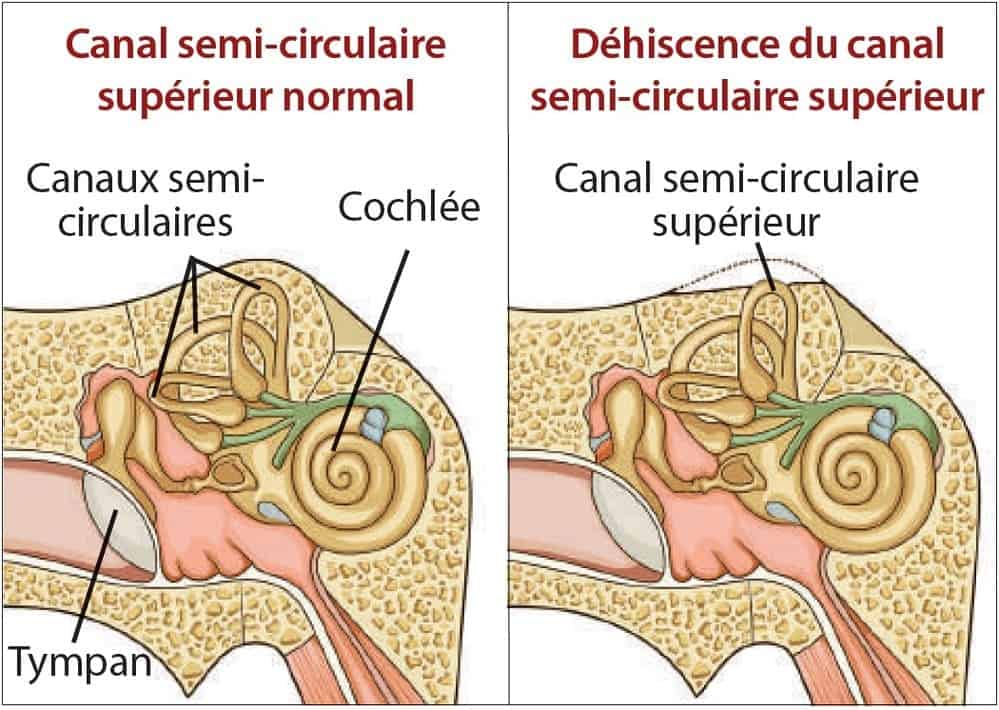 canal semi circulaire