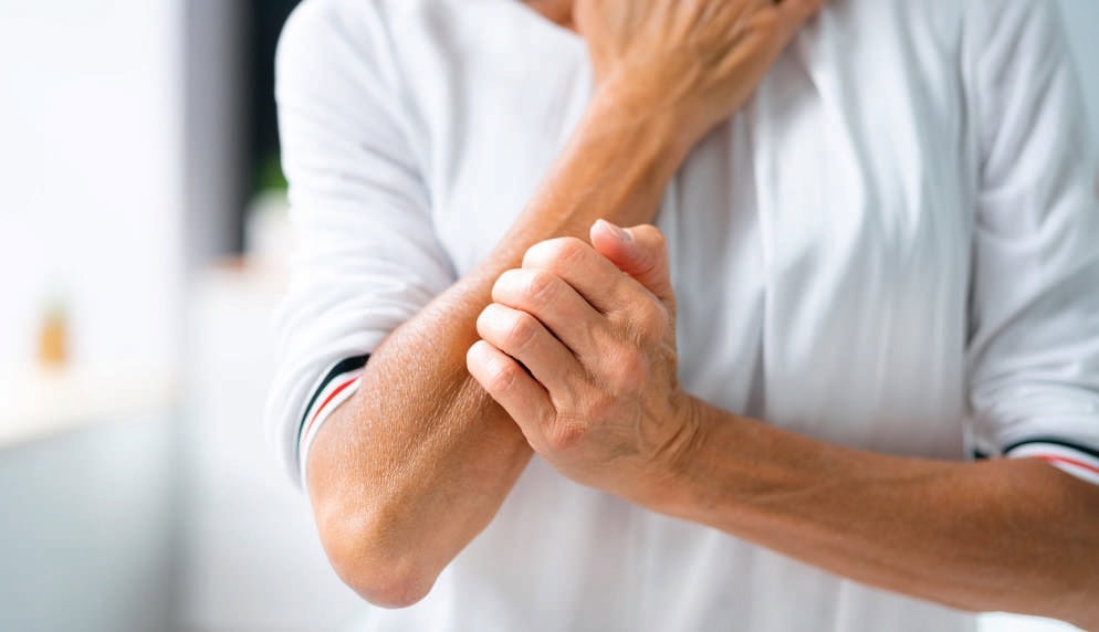 psoriasis
