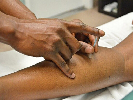 acupuncture